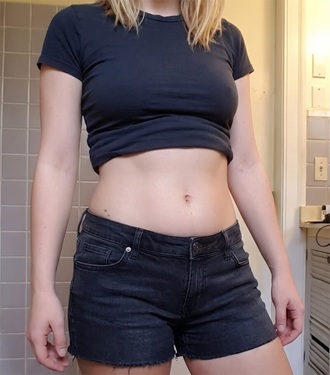 Patient after 14 days — flat abdomen